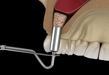 a digital illustration of a sinus lift procedure