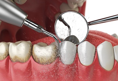 3D render of a dental cleaning
