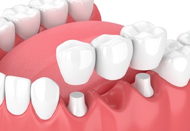 Illustration of dental bridge being placed on prepared teeth