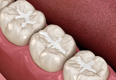 A 3D illustration of tooth-colored fillings