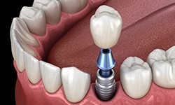 Animated dnetal implant supported dental crown