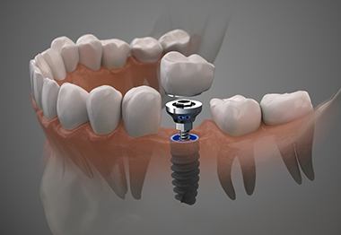 digital illustration of a single tooth dental implant placed in a jawbone