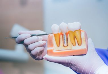 a dentist holding a model of a dental implant