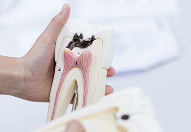 Dentist holding model of decayed tooth