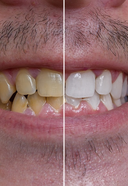 Before and after results of teeth whitening.