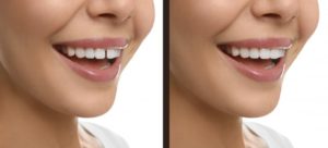 woman with gap in teeth before and after dental bonding 